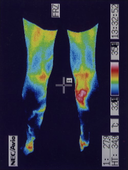 Thermography test for blood flow in the calf