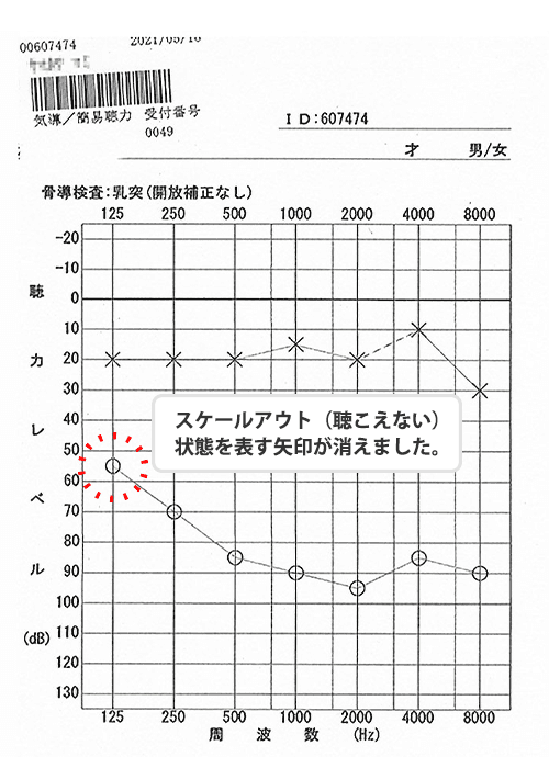 Hearing recovery began with acupuncture treatment. audiogram