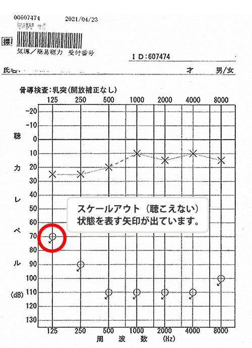 Audiogram of the entire area scaled out immediately after discharge from the hospital for sudden hearing loss