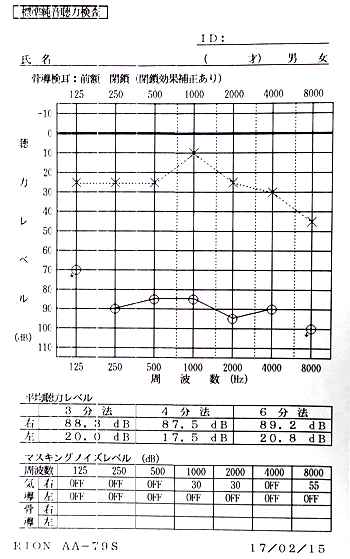 Audiograms for hearing loss that does not respond to steroids/isobarbital