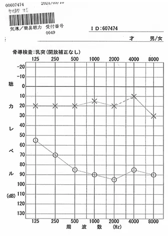 Audiogram shows hearing recovery started with acupuncture treatment