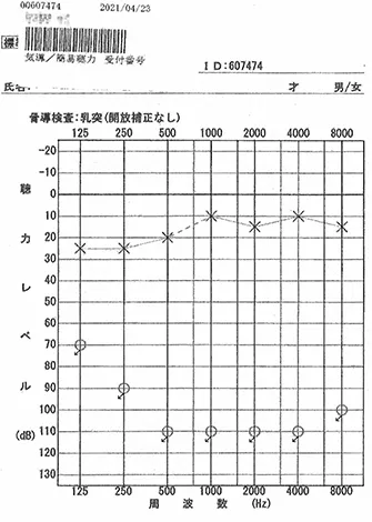 Audiogram with full scale out immediately after discharge from hospital due to sudden hearing loss