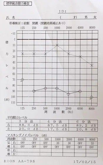 Auditory replacement phenomenon Pre-treatment audiogram