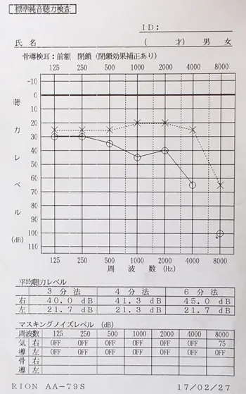 Auditory replacement phenomenon Post-treatment audiogram