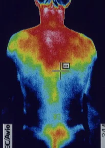Left ear sudden hearing loss caused by viral infection｜Thermal image
