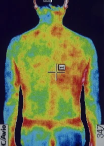 Stress-induced left ear sudden hearing loss｜Thermal imaging camera image
