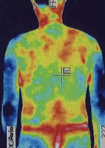 Left ear sudden hearing loss caused by deterioration of blood circulation｜Thermal imaging camera image
