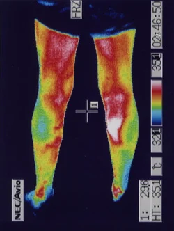 Calf blood flow improved by acupuncture｜Thermographic image after treatment