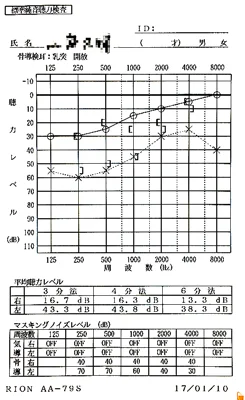 Sudden hearing loss｜5 months after onset