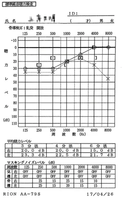 Sudden hearing loss｜8 months after onset