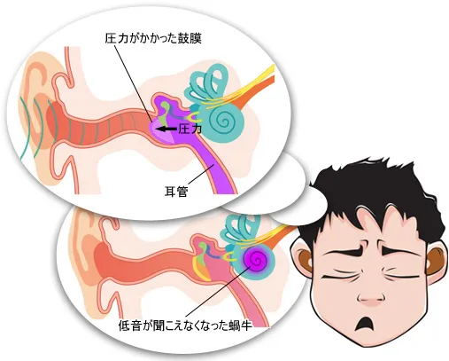 Cochlea with pressure on the eardrum and loss of low tone hearing/cochlea with loss of low tone hearing due to inner ear damage