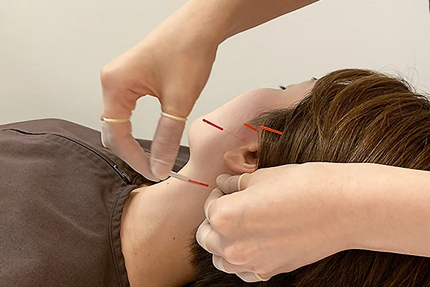 Acupuncture treatment for sudden hearing loss