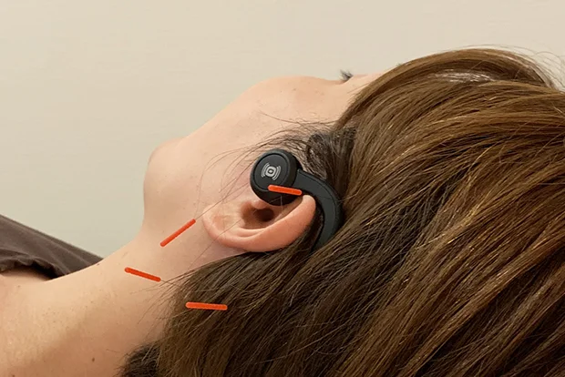 Moriue Acupuncture and Osteopathy Clinic：Acupuncture for sudden hearing loss