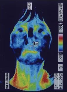 Thermographic image before treatment