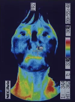 Ear obstruction (ear congestion) Thermographic examination before acupuncture treatment