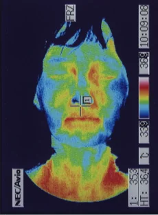 Thermographic image after treatment