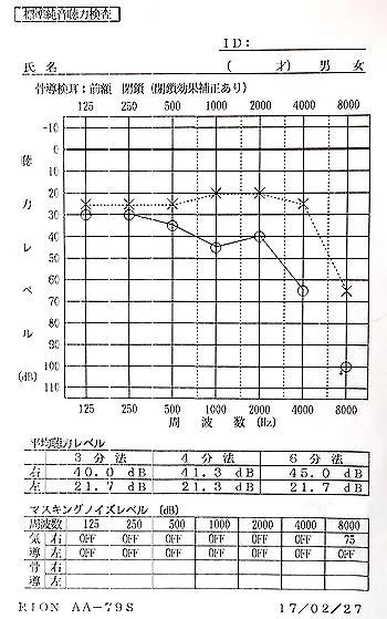 Post-treatment audiogram