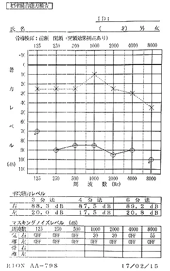 Pre-treatment audiogram